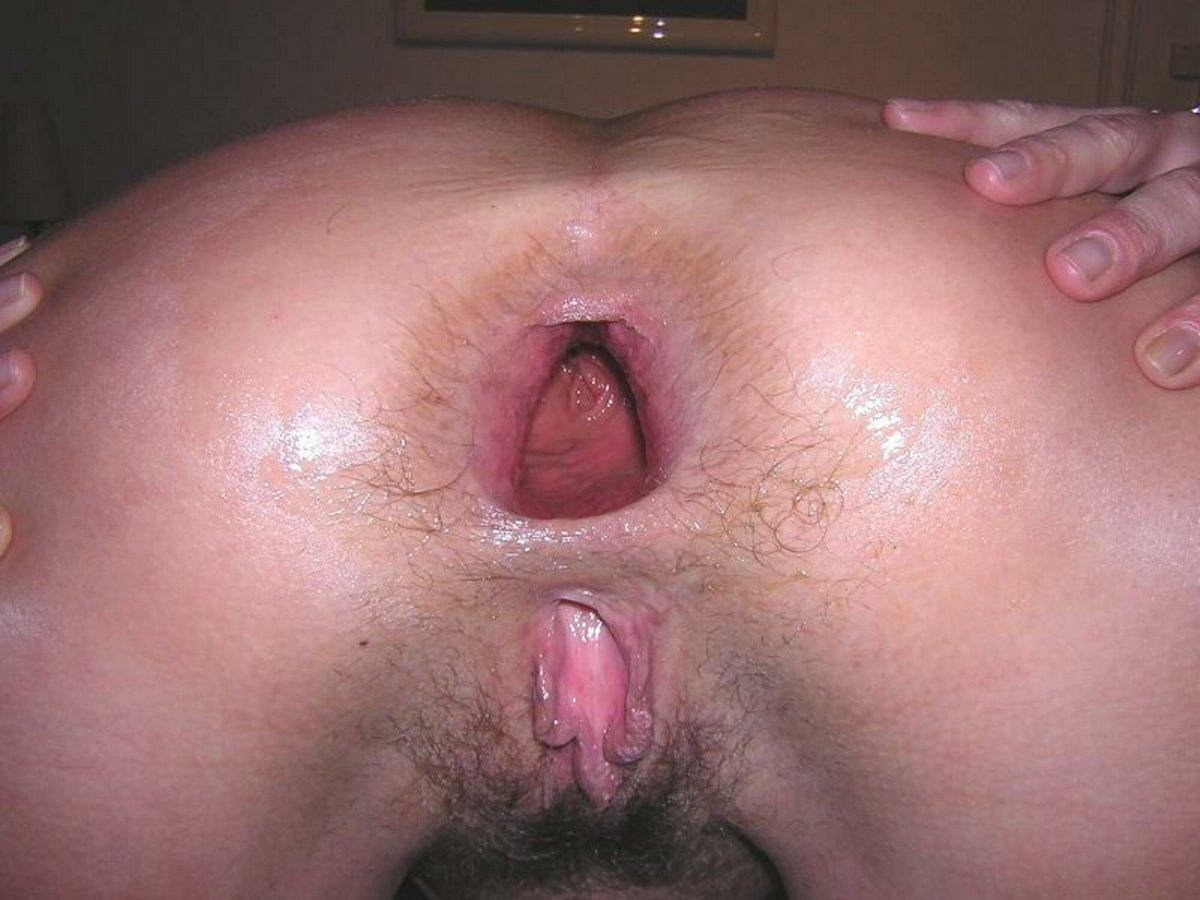 Swelling of anus